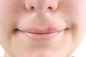Mitos sobre el herpes labial