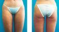 lipoescultura-enzimatica-un-metodo-no-quirurgico-contra-la-obesidad-localizada