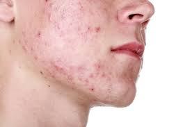 Como distinguir la rosacea del acne?